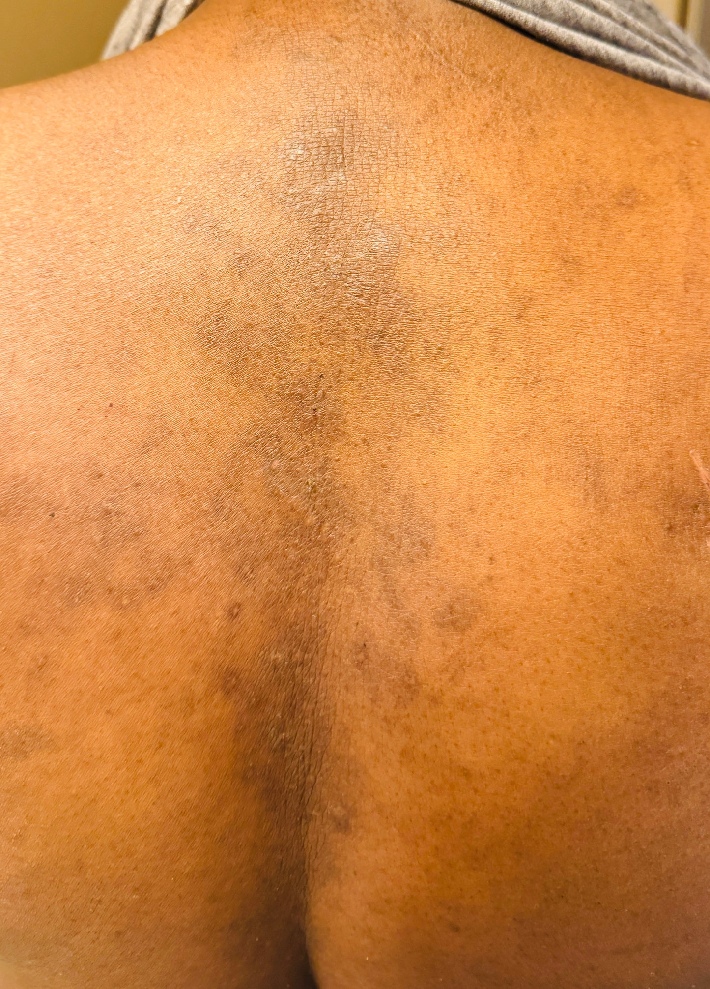 Eczema Healing Balm - Powered by Sulfur